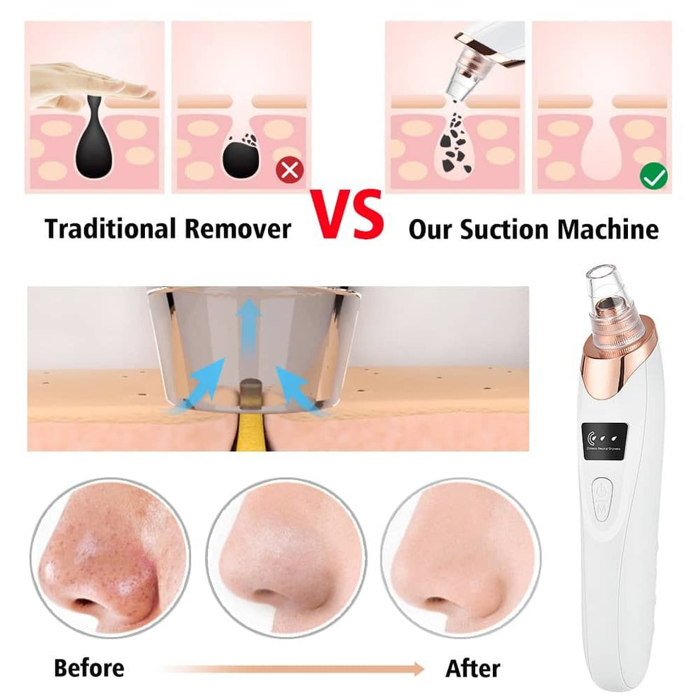 5 in 1 Blackhead remover | Derma Suction | Rechargeable | Free Gift Card 🎁